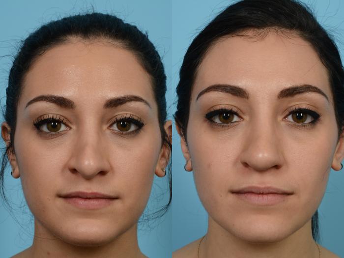 Before & After Revision Rhinoplasty by Dr. Mustoe Case 543 View #2 View in Chicago, IL