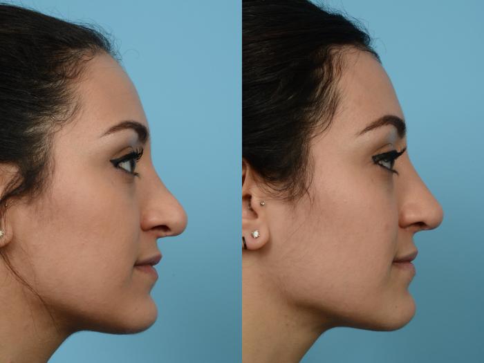 Before & After Revision Rhinoplasty by Dr. Mustoe Case 543 View #3 View in Chicago, IL