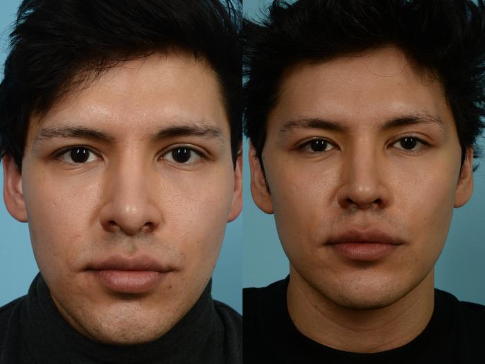Before & After Revision Rhinoplasty by Dr. Mustoe Case 938 Front View in Chicago, IL
