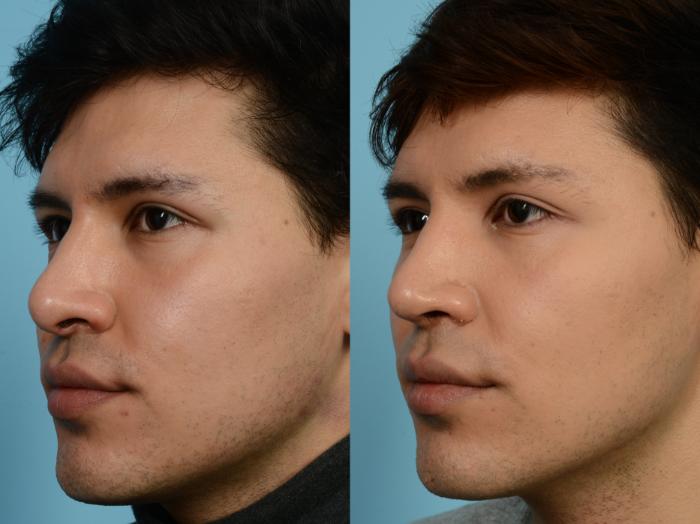 Before & After Revision Rhinoplasty by Dr. Mustoe Case 938 Left Oblique View in Chicago, IL