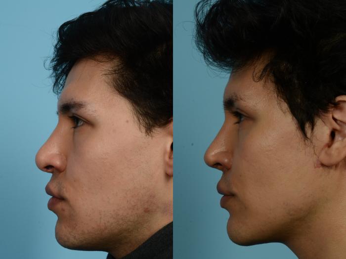 Before & After Revision Rhinoplasty by Dr. Mustoe Case 938 Left Side View in Chicago, IL