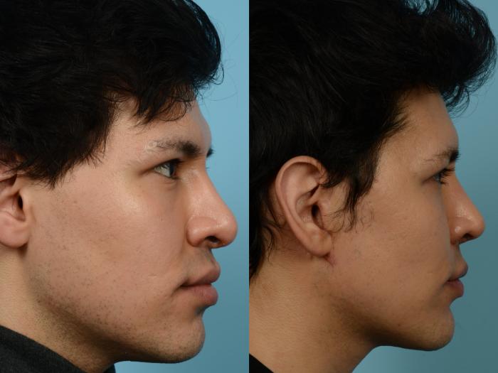Before & After Revision Rhinoplasty by Dr. Mustoe Case 938 Right Side View in Chicago, IL