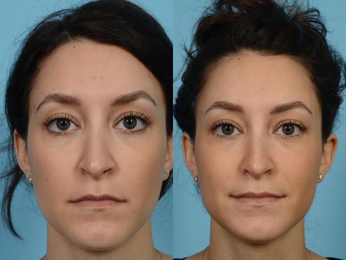 Before & After Revision Rhinoplasty by Dr. Mustoe Case 957 Front View in Chicago, IL