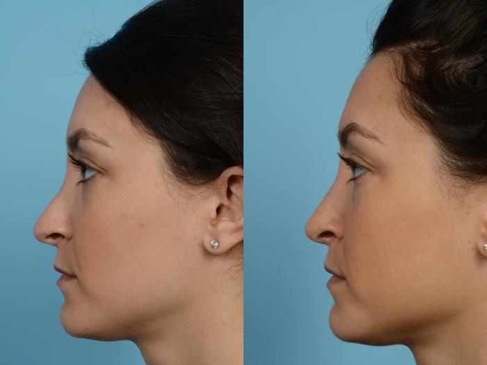 Before & After Revision Rhinoplasty by Dr. Mustoe Case 957 Left Side View in Chicago, IL