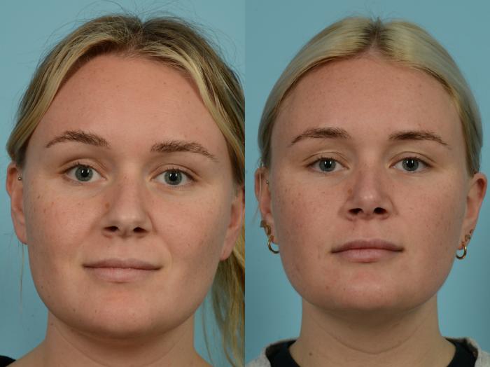 Before & After Revision Rhinoplasty by Dr. Mustoe Case 960 Front View in Chicago, IL