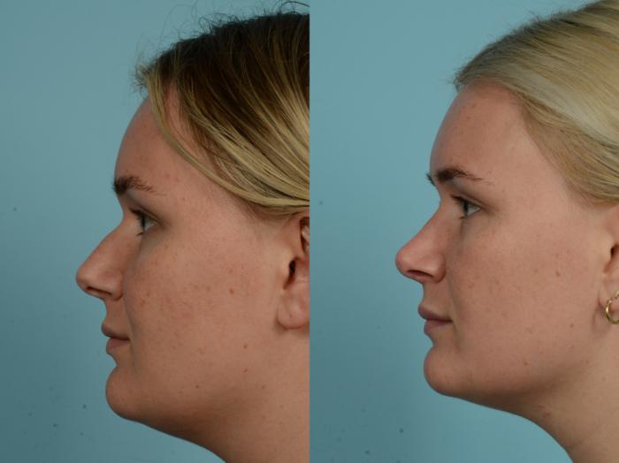 Before & After Revision Rhinoplasty by Dr. Mustoe Case 960 Left Side View in Chicago, IL