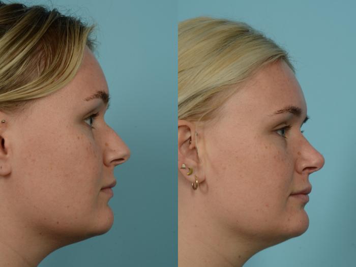 Before & After Revision Rhinoplasty by Dr. Mustoe Case 960 Right Side View in Chicago, IL