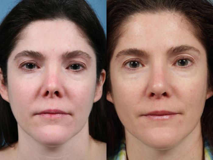 Before & After Revision Rhinoplasty by Dr. Mustoe Case 98 View #2 View in Chicago, IL