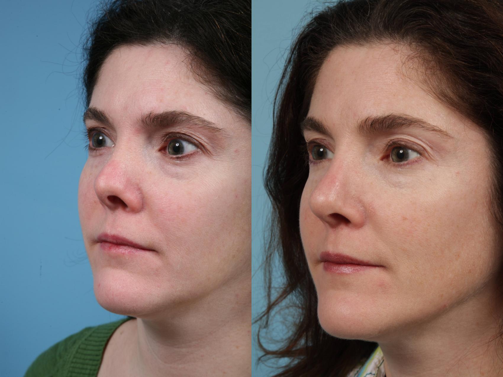 Before & After Revision Rhinoplasty by Dr. Mustoe Case 98 View #3 View in Chicago, IL