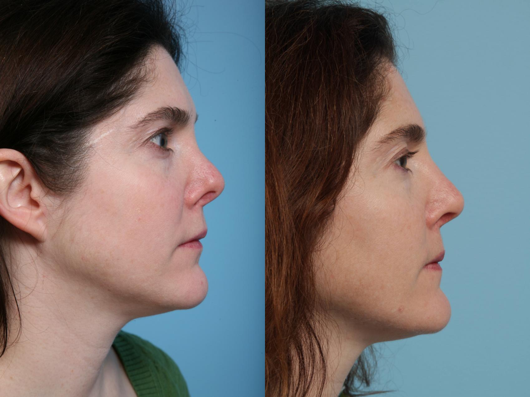 Before & After Revision Rhinoplasty by Dr. Mustoe Case 98 View #4 View in Chicago, IL