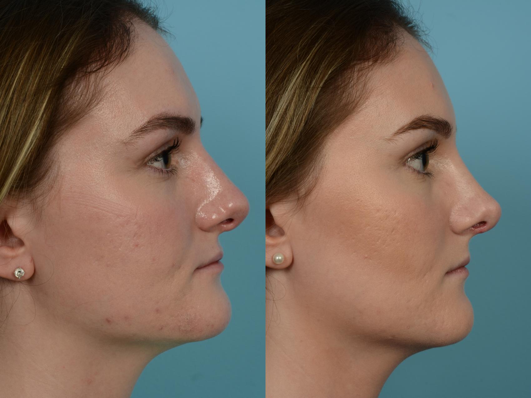 Dr. Sinno Revision Rhinoplasty in Chicago, Illinois