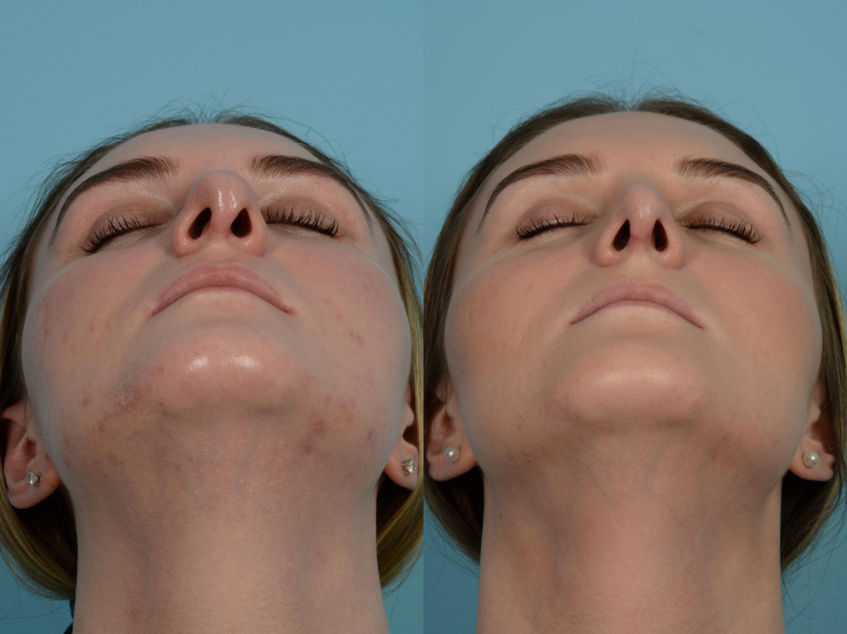 Dr. Sinno Revision Rhinoplasty in Chicago, Illinois