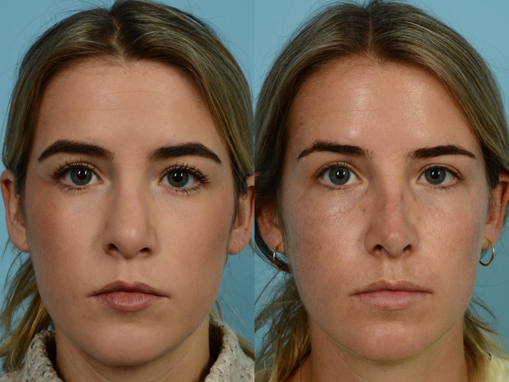 Dr. Sinno Revision Rhinoplasty in Chicago, Illinois