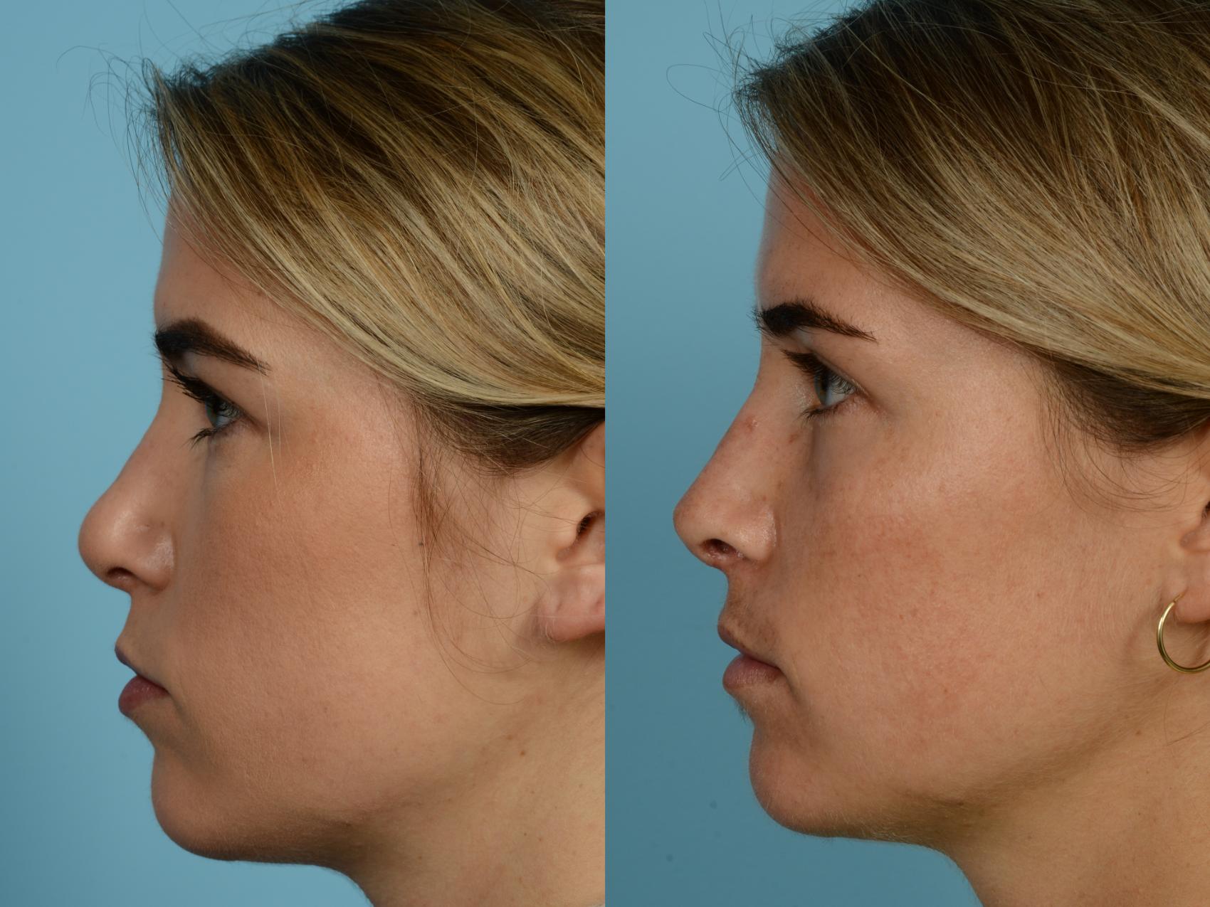 Dr. Sinno Revision Rhinoplasty in Chicago, Illinois