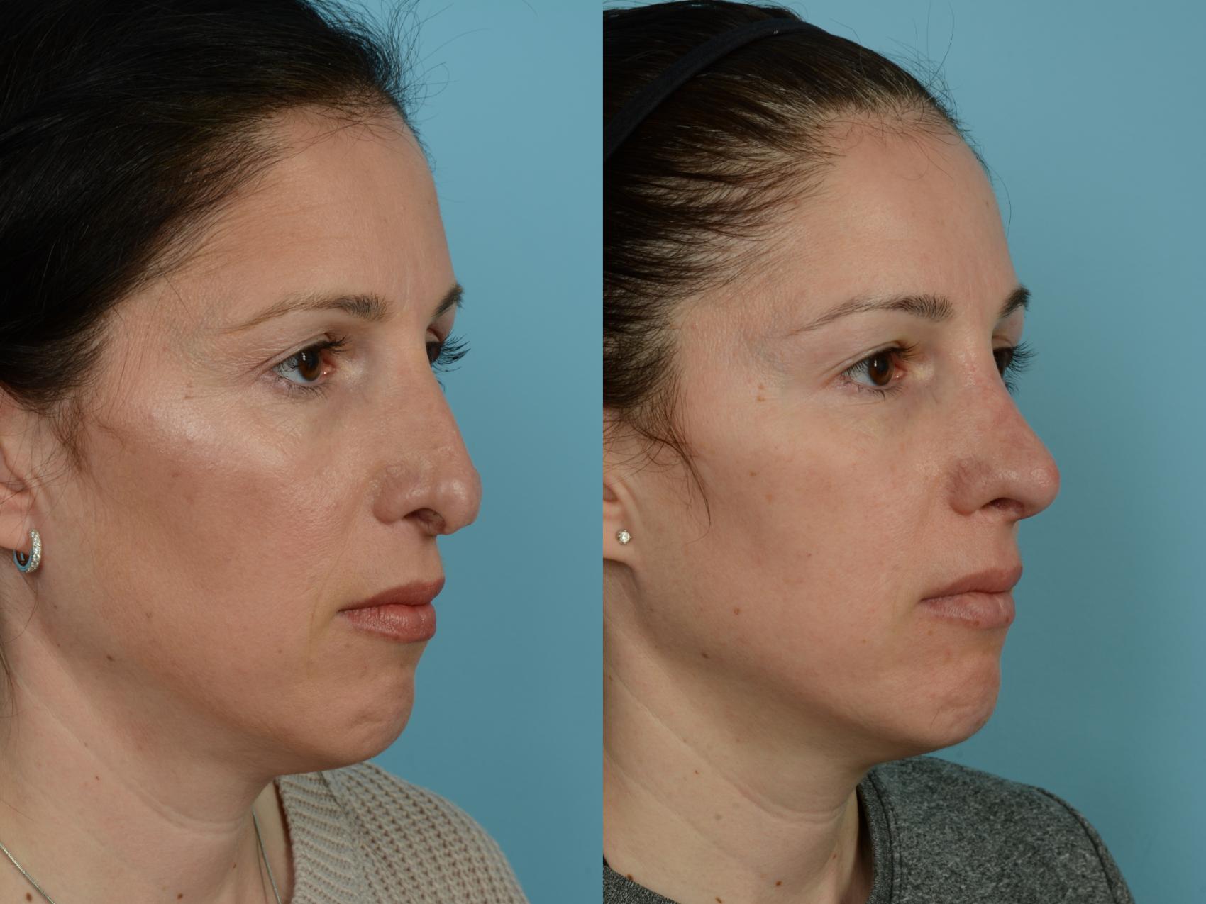 Dr. Sinno Revision Rhinoplasty in Chicago, Illinois