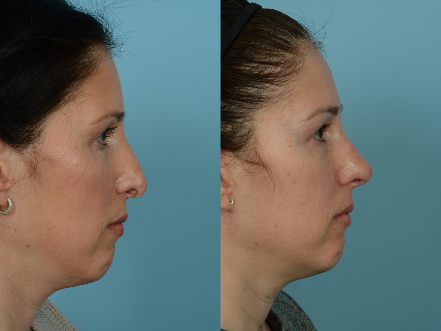 Dr. Sinno Revision Rhinoplasty in Chicago, Illinois