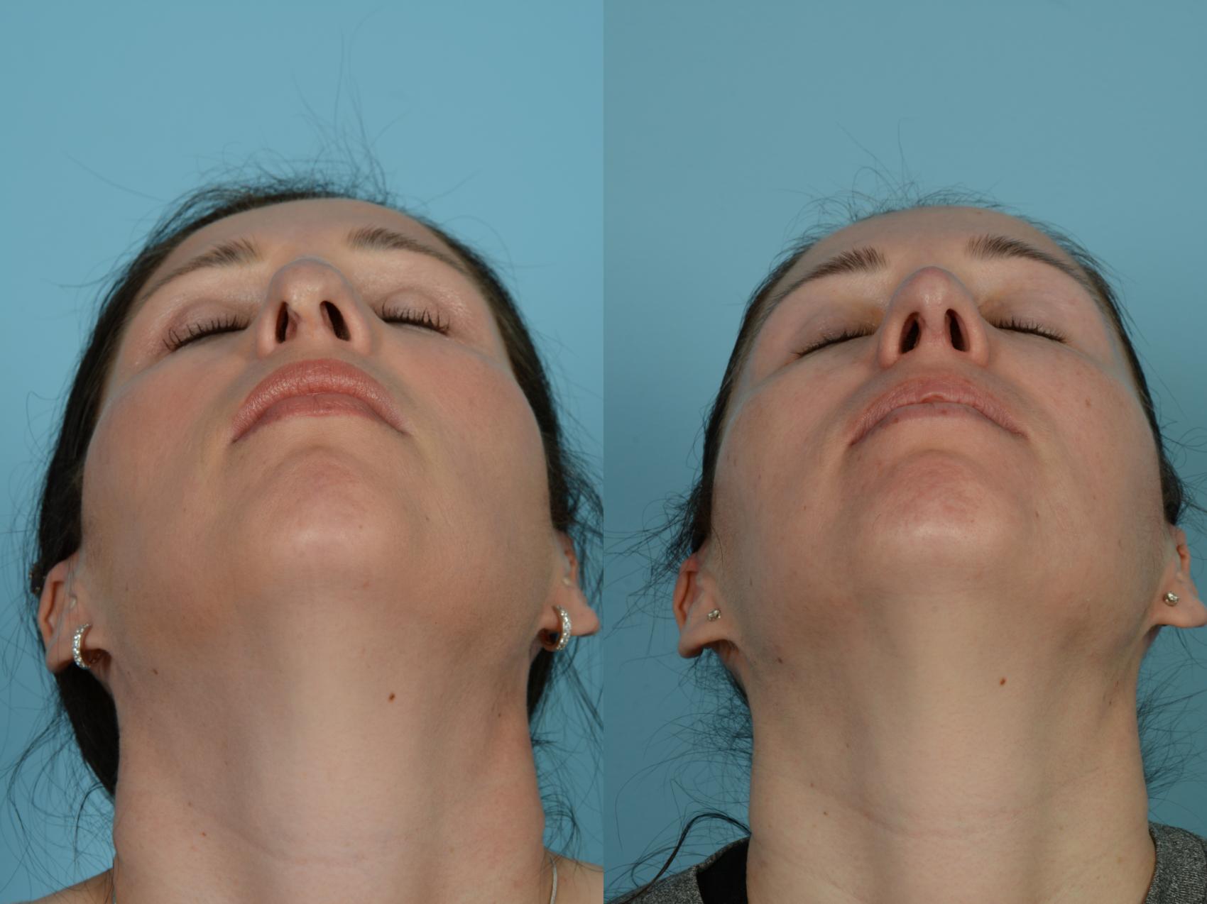 Dr. Sinno Revision Rhinoplasty in Chicago, Illinois