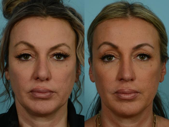 Before & After Revision Rhinoplasty by Dr. Sinno Case 904 Front View in Chicago, IL