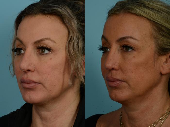 Before & After Revision Rhinoplasty by Dr. Sinno Case 904 Left Oblique View in Chicago, IL