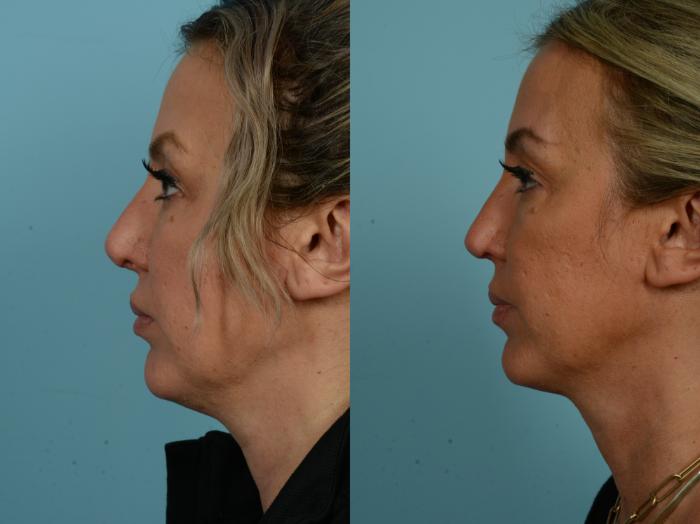 Before & After Revision Rhinoplasty by Dr. Sinno Case 904 Left Side View in Chicago, IL