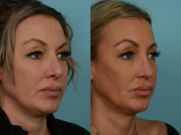 Before & After Revision Rhinoplasty by Dr. Sinno Case 904 Right Oblique View in Chicago, IL