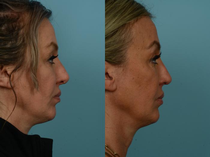 Before & After Revision Rhinoplasty by Dr. Sinno Case 904 Right Side View in Chicago, IL