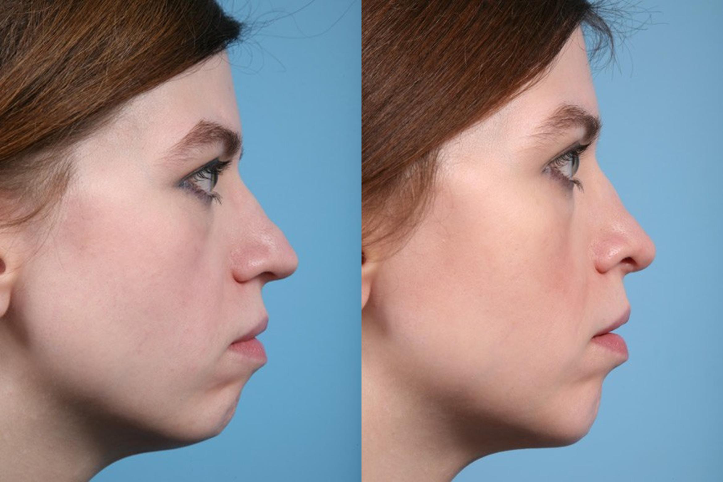 Before & After Rhinoplasty by Dr. Mustoe Case 1 View #2 View in Chicago, IL