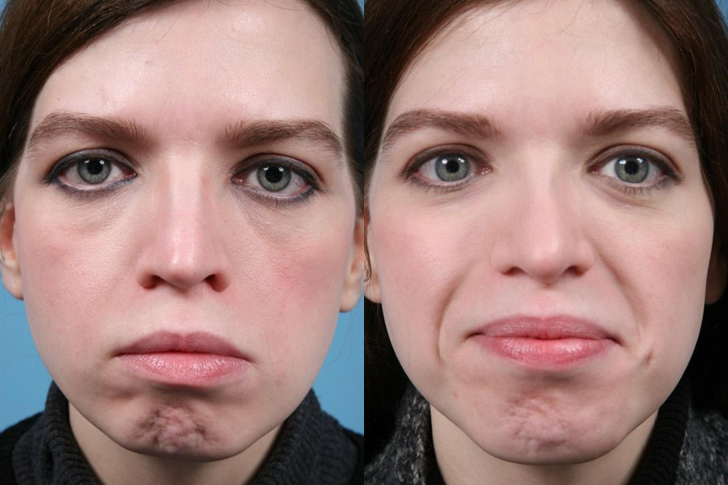 Before & After Rhinoplasty by Dr. Mustoe Case 1 View #3 View in Chicago, IL