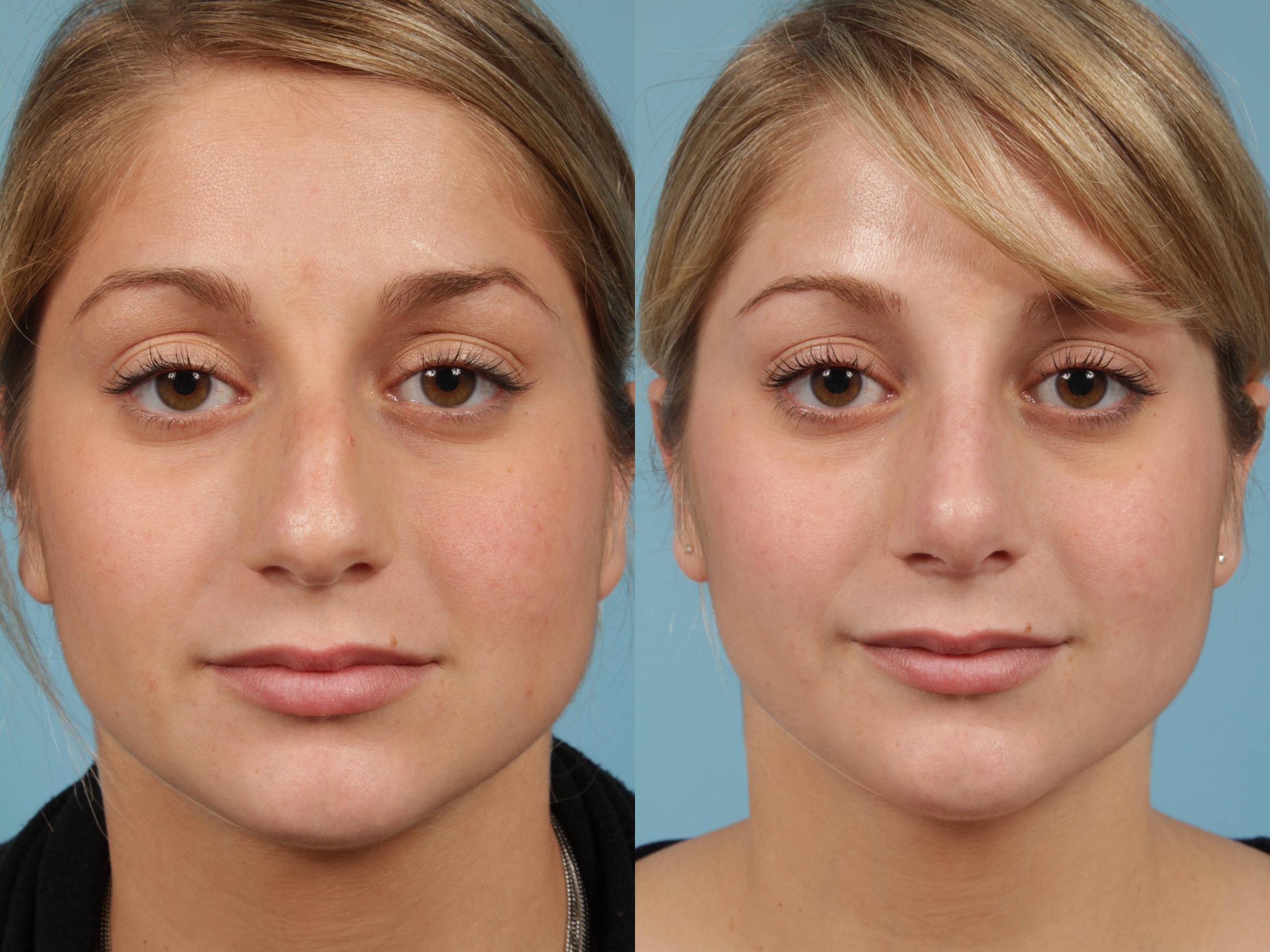 Rhinoplasty Before & After Photos Patient 194 | Chicago, IL | TLKM ...