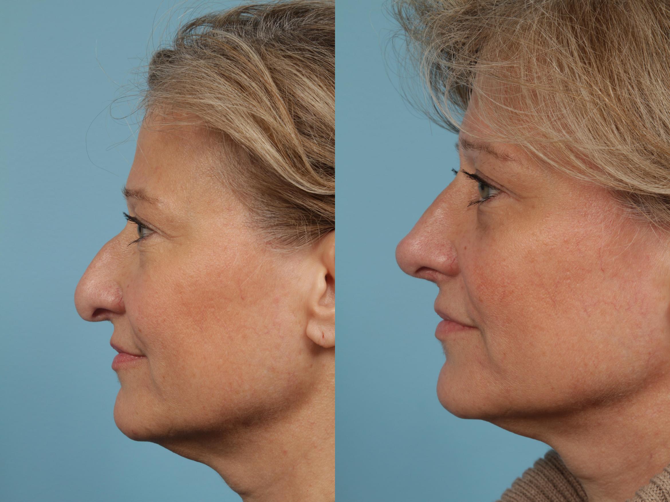 Before & After Rhinoplasty by Dr. Mustoe Case 214 View #1 View in Chicago, IL