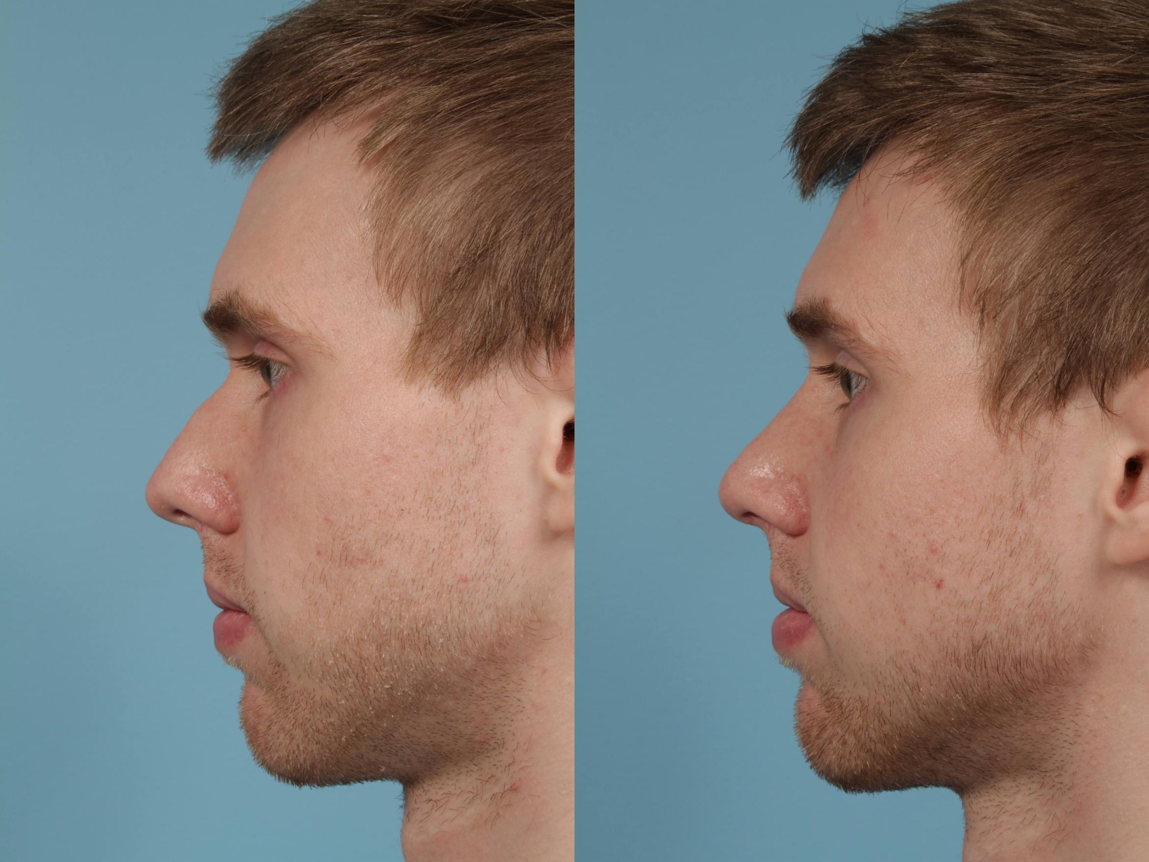 Before & After Rhinoplasty by Dr. Mustoe Case 231 View #1 View in Chicago, IL