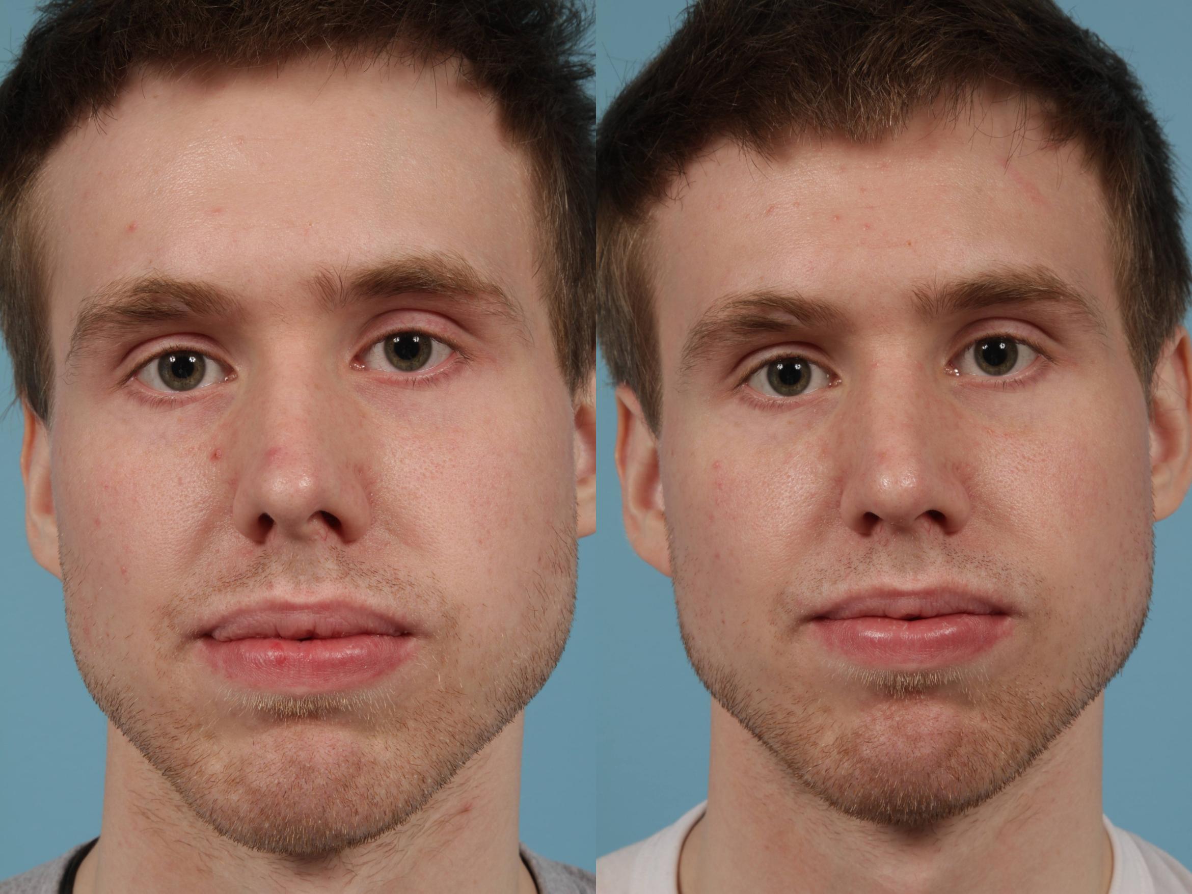 Before & After Rhinoplasty by Dr. Mustoe Case 231 View #2 View in Chicago, IL