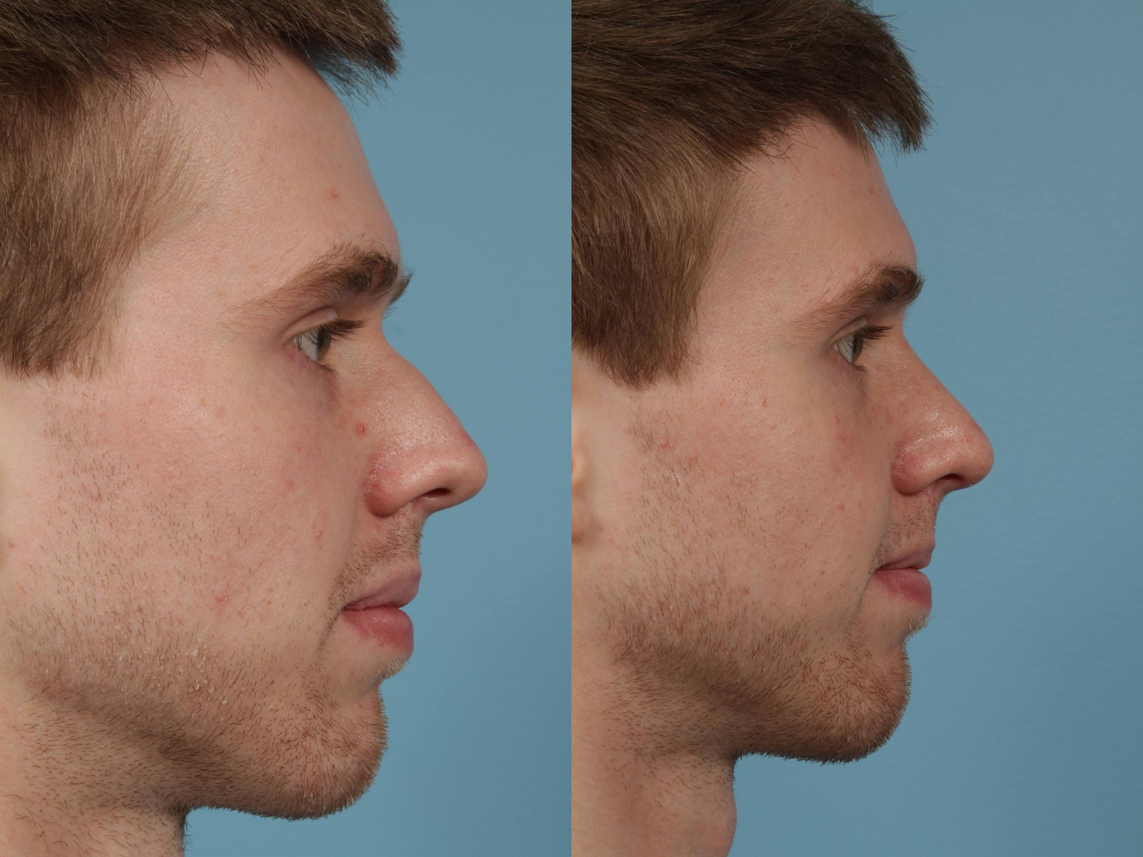 Before & After Rhinoplasty by Dr. Mustoe Case 231 View #3 View in Chicago, IL