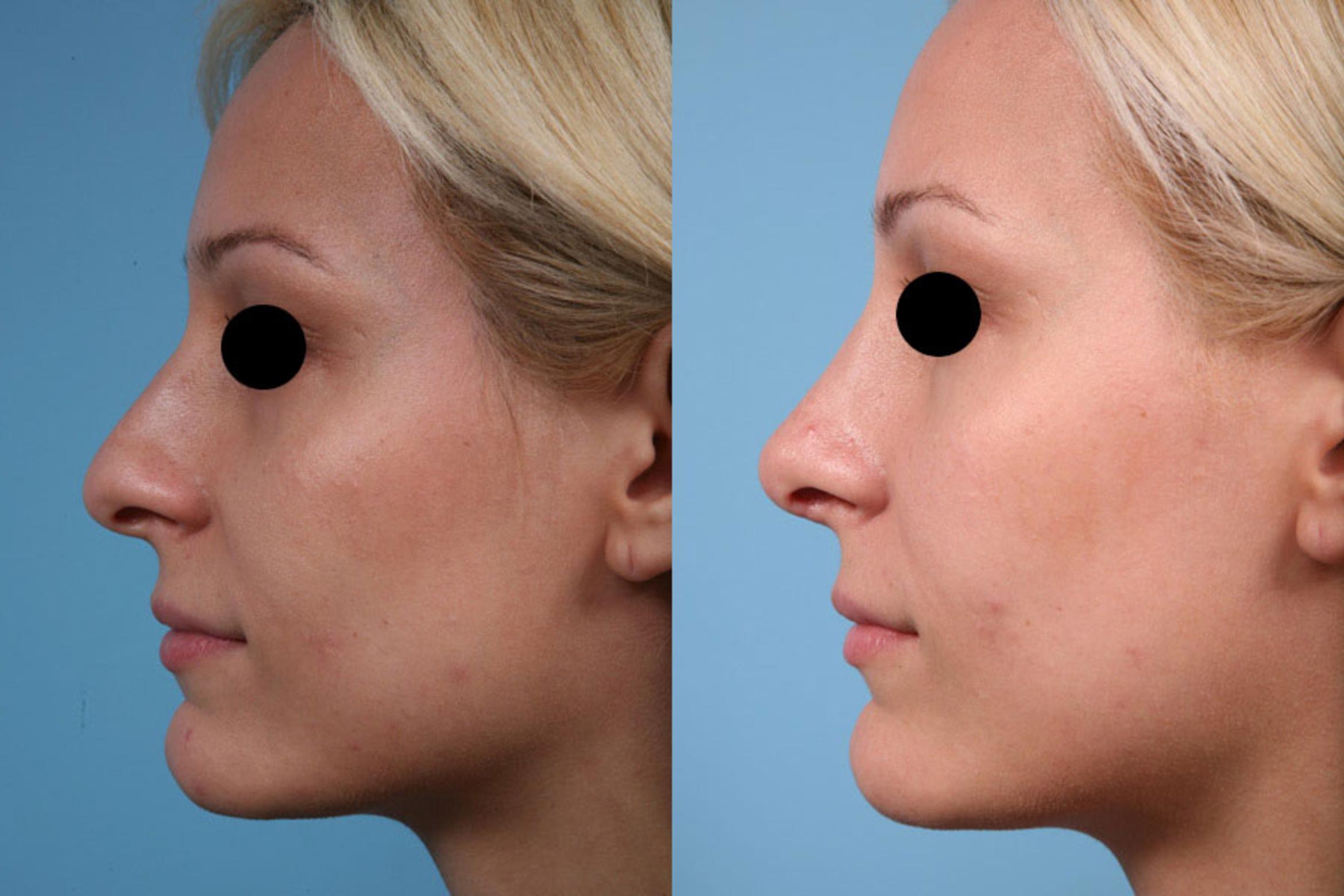 Rhinoplasty Before & After Photos Patient 24 Chicago, IL TLKM