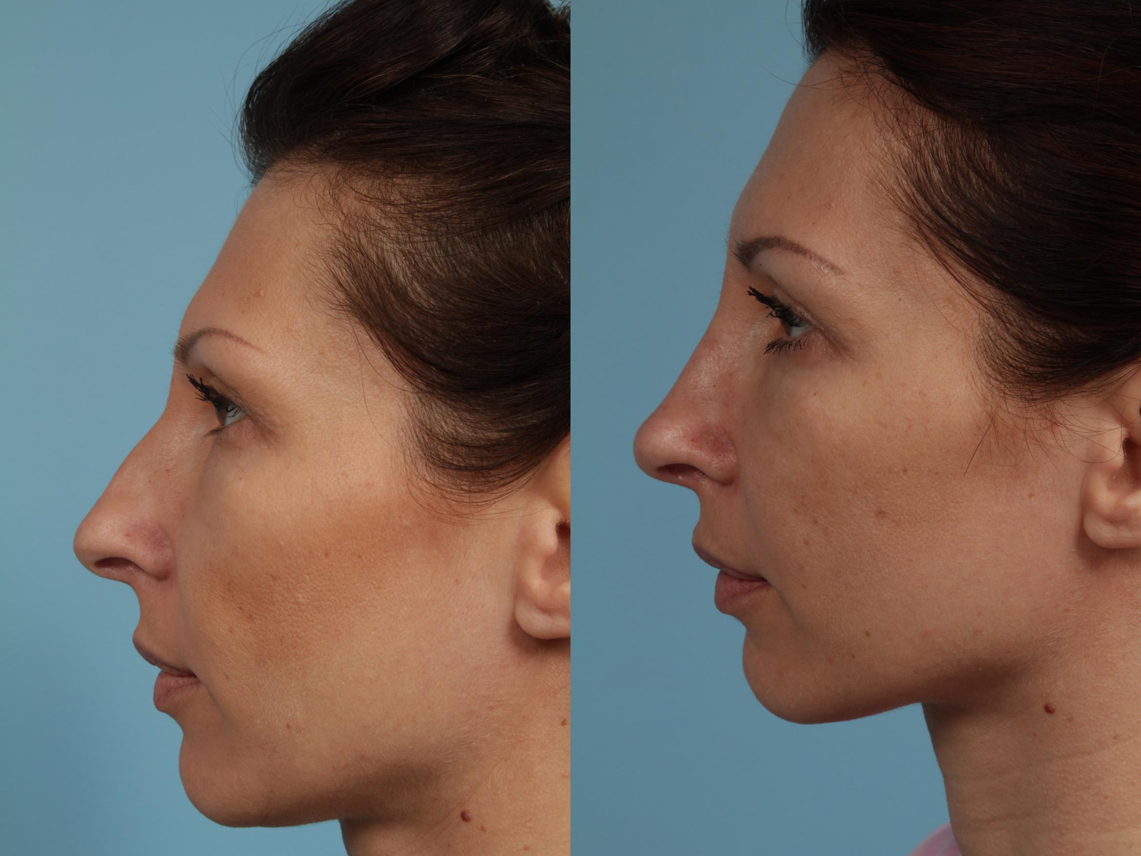 Rhinoplasty by Dr. Mustoe Case 289 Before & After View #1 | Chicago, IL | TLKM Plastic Surgery