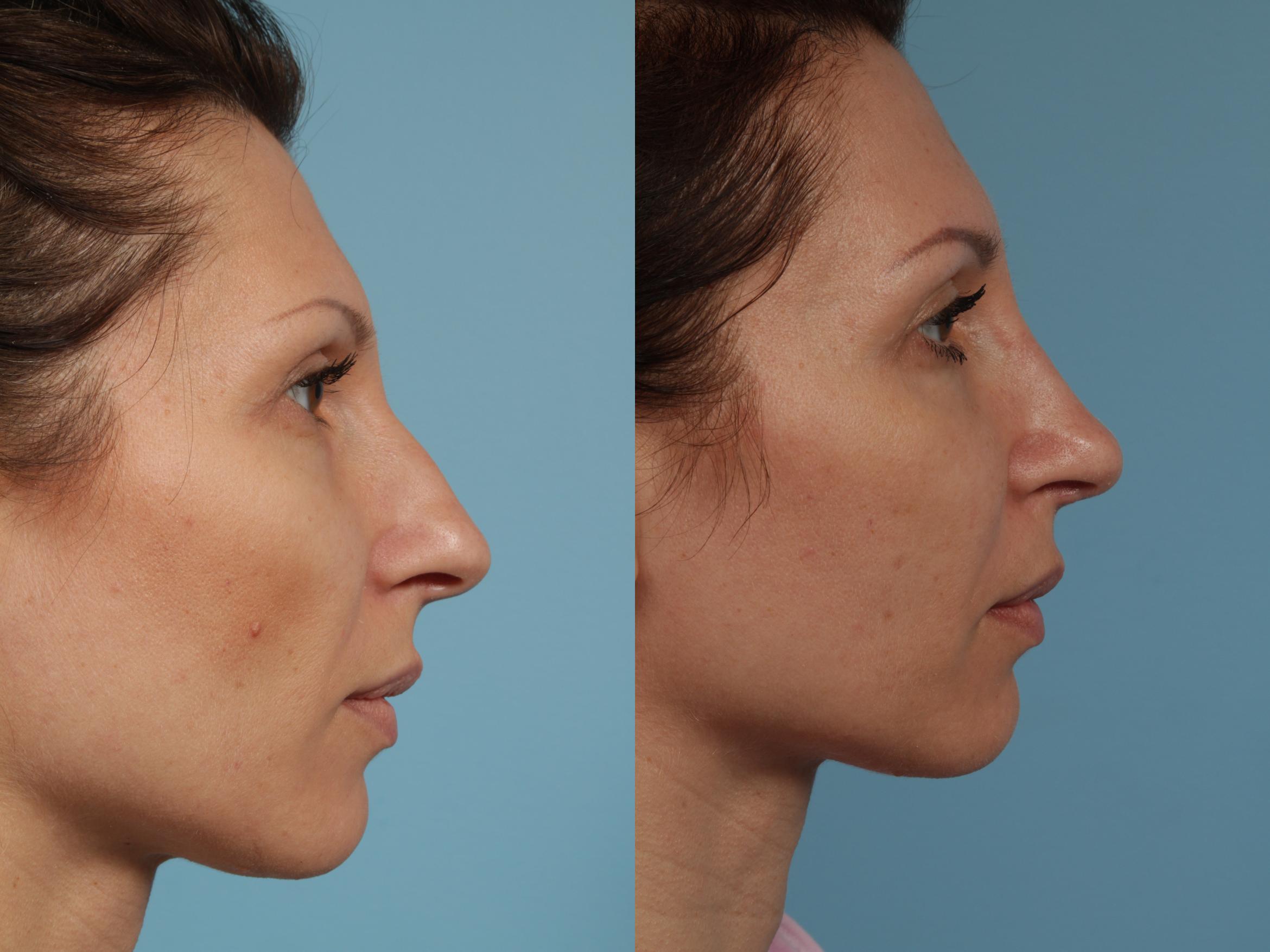 Before & After Rhinoplasty by Dr. Mustoe Case 289 View #4 View in Chicago, IL