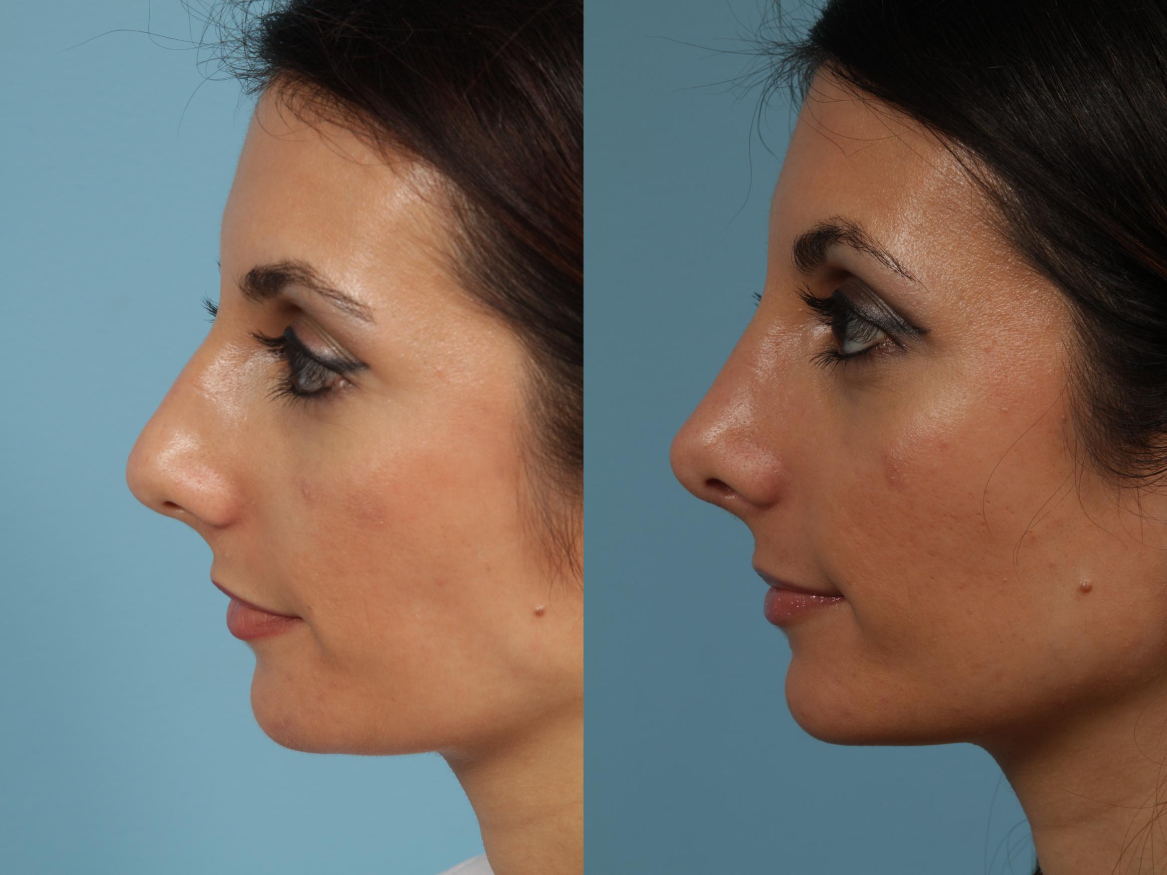 Rhinoplasty Surgeon Austin