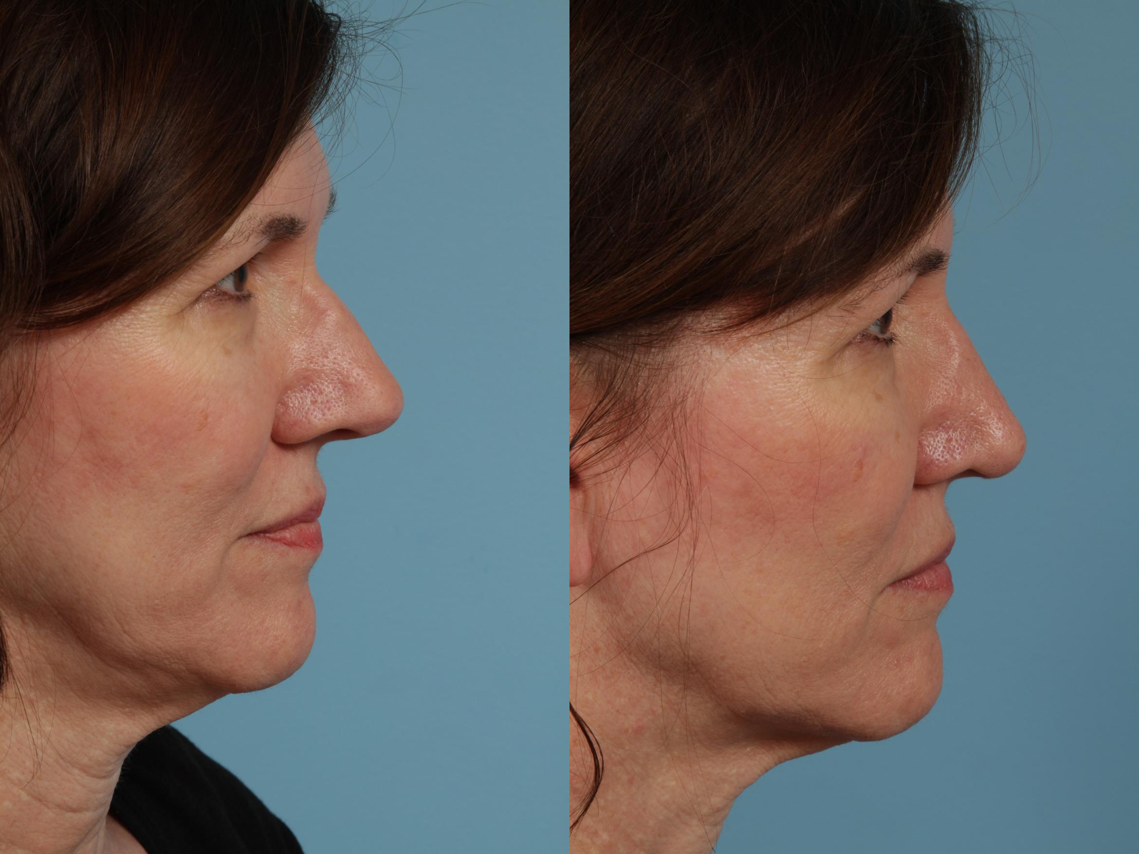 Rhinoplasty Before And After Photos Patient 326 Chicago Il Tlkm Plastic Surgery 