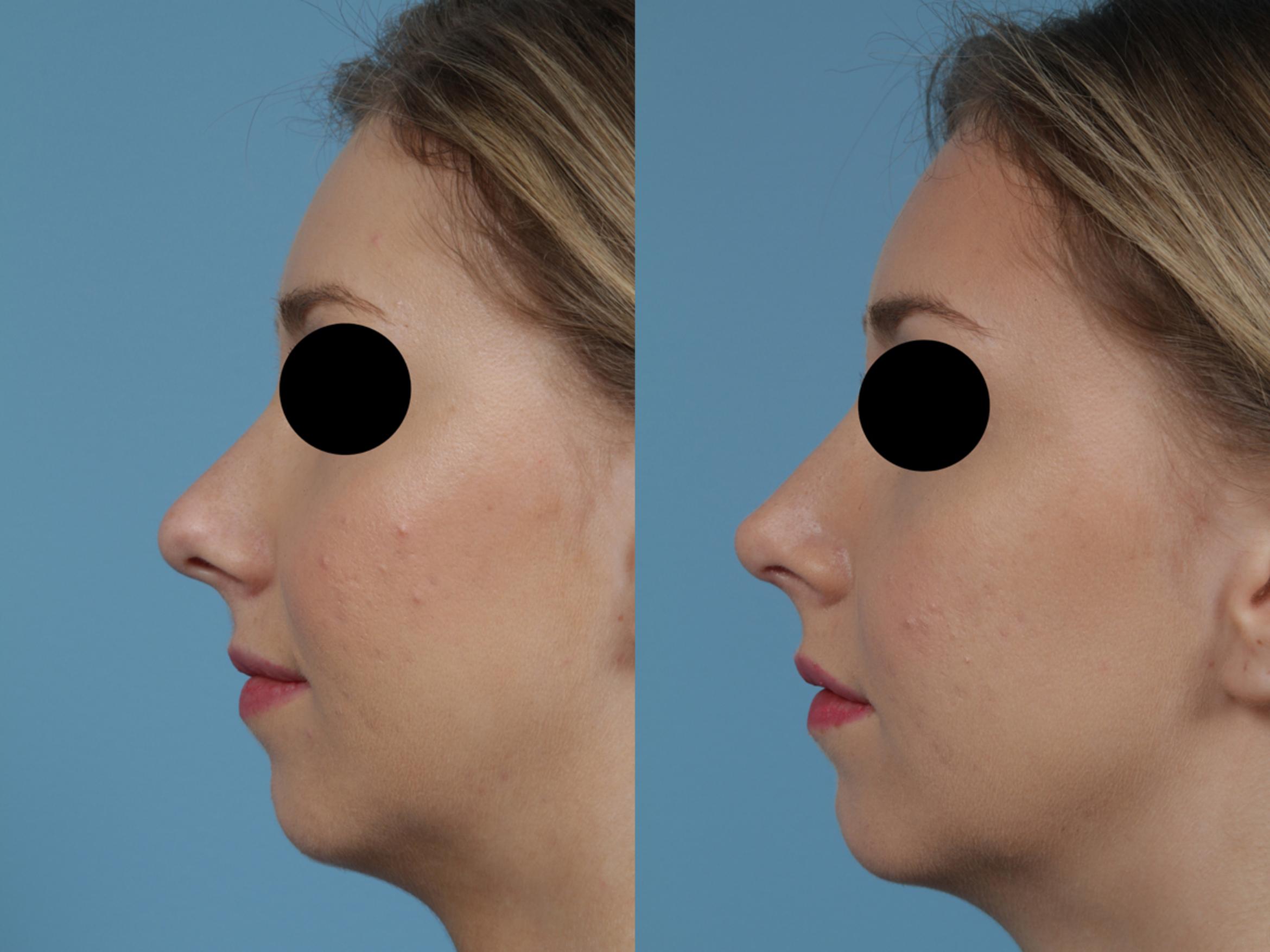 Before & After Rhinoplasty by Dr. Mustoe Case 358 View #1 View in Chicago, IL