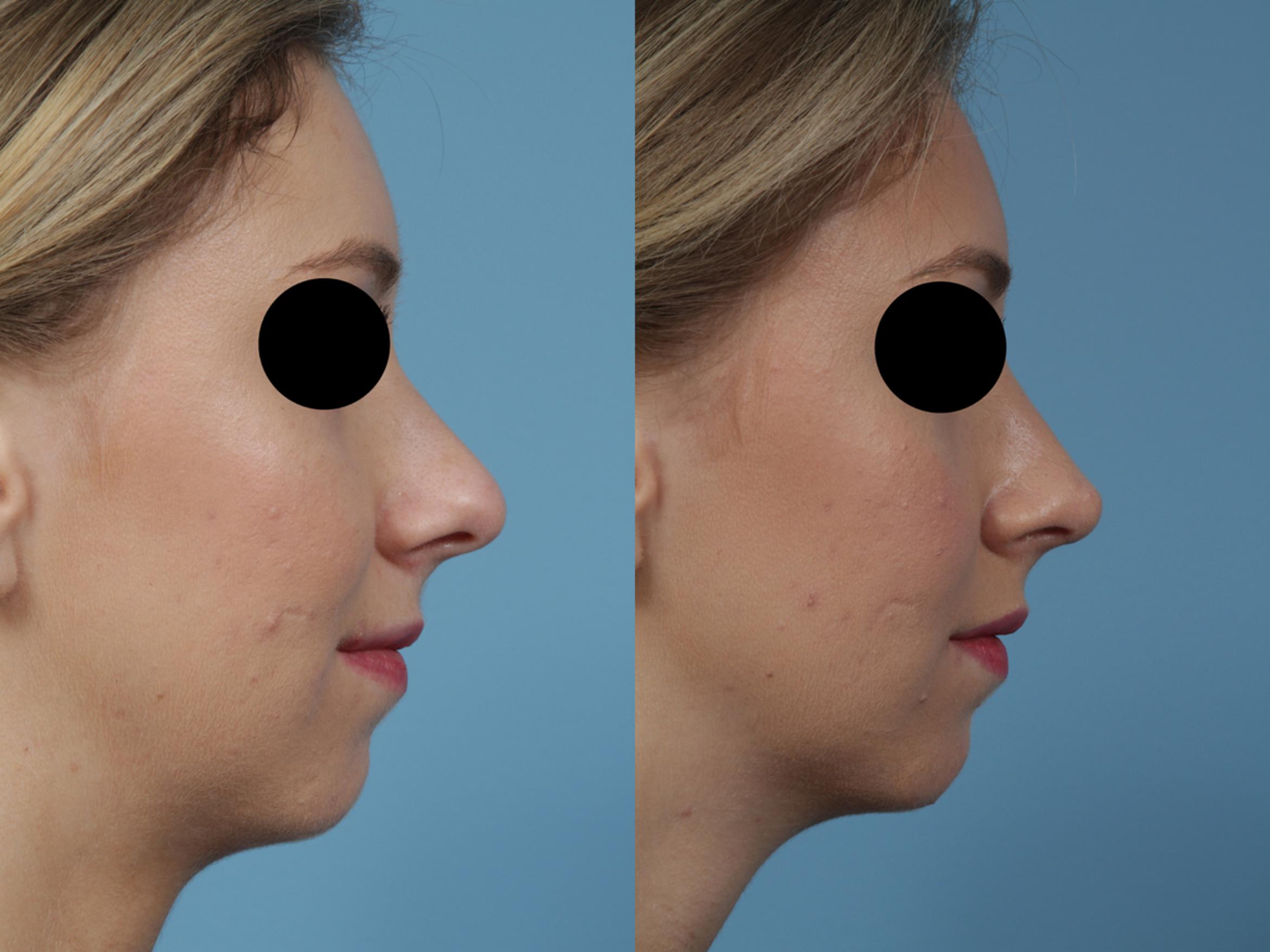 Before & After Rhinoplasty by Dr. Mustoe Case 358 View #3 View in Chicago, IL