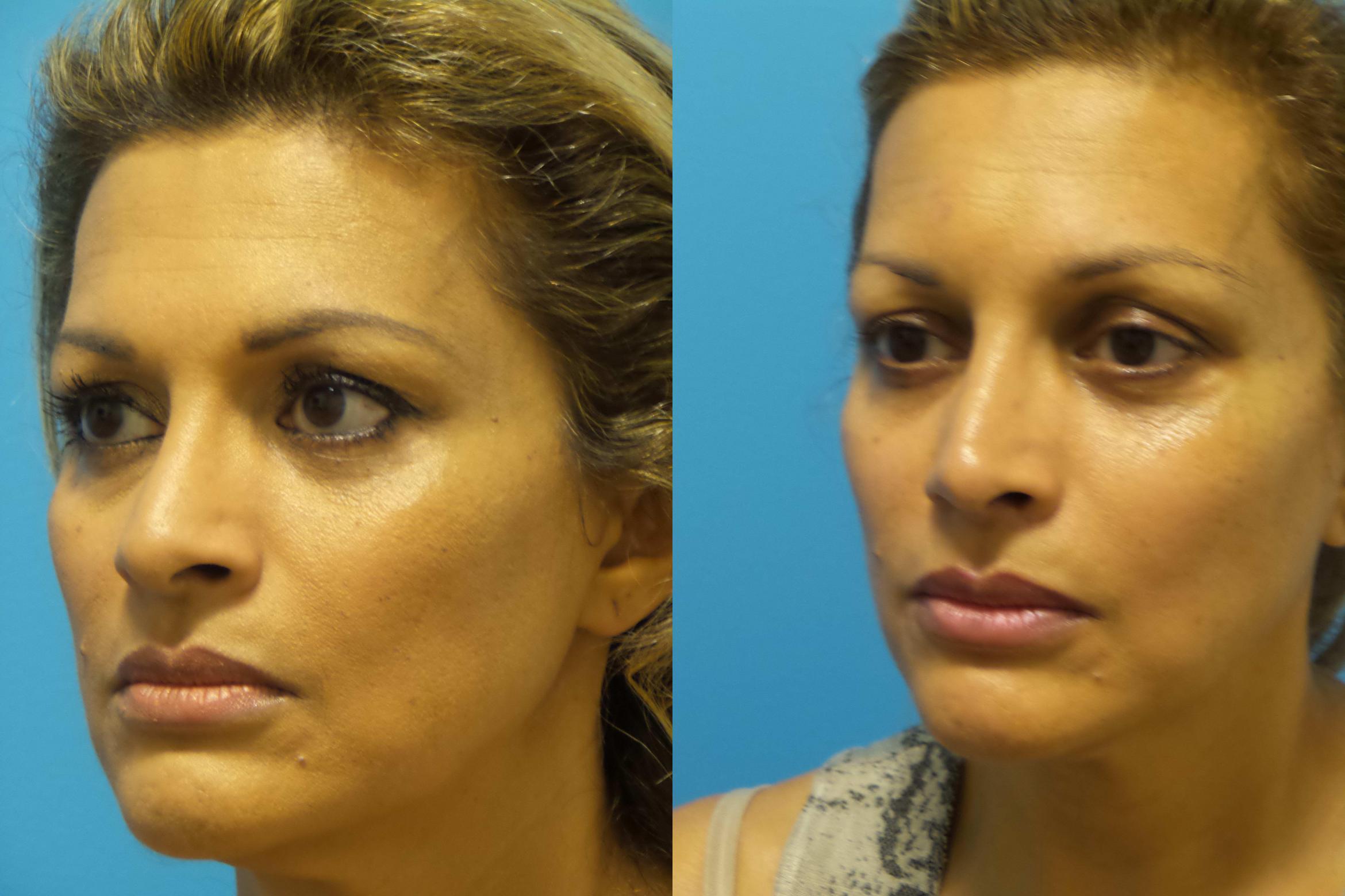 Rhinoplasty Before & After Photos Patient 435 | Chicago, IL | TLKM ...