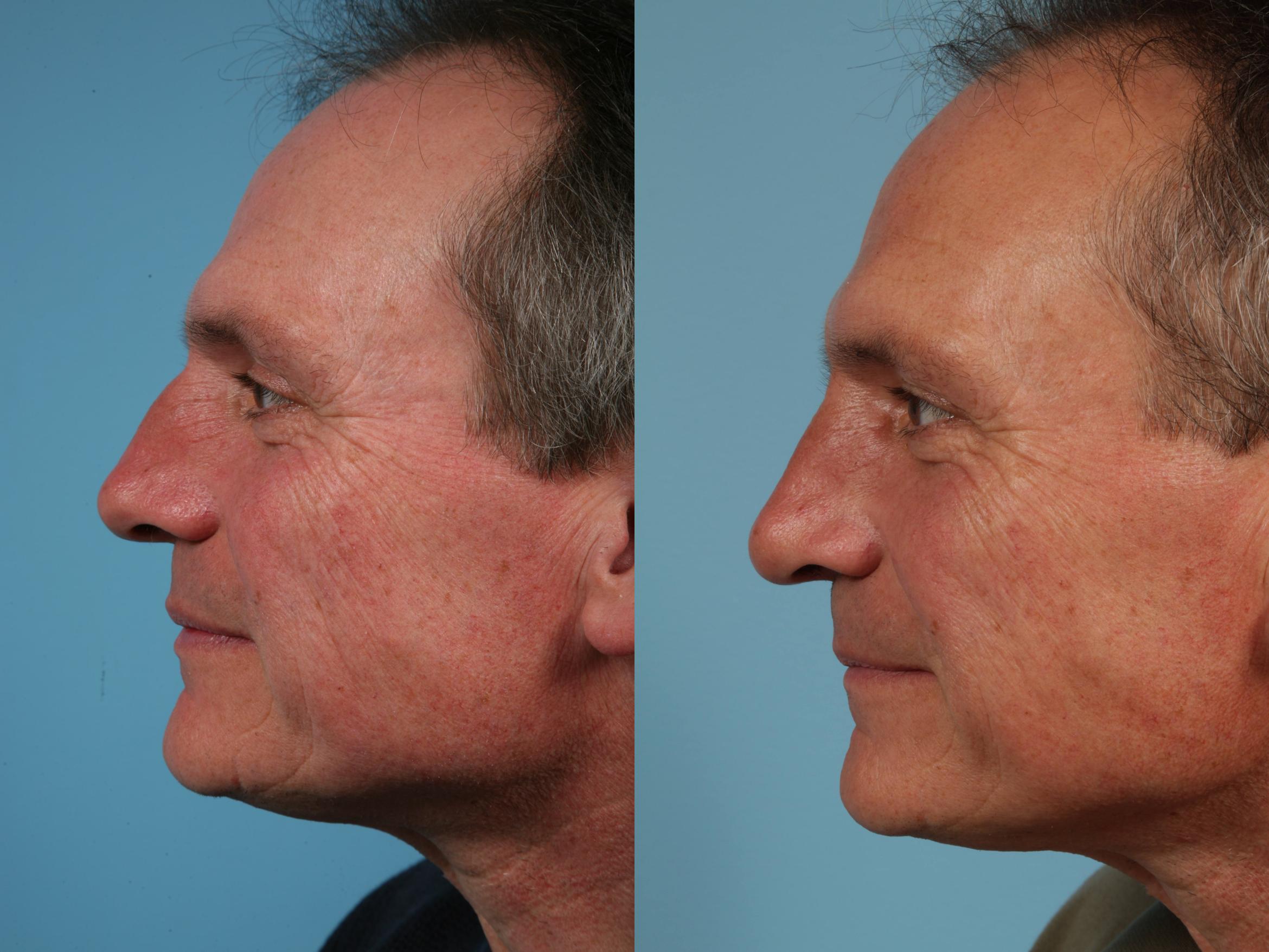 Before & After Rhinoplasty by Dr. Mustoe Case 45 View #1 View in Chicago, IL