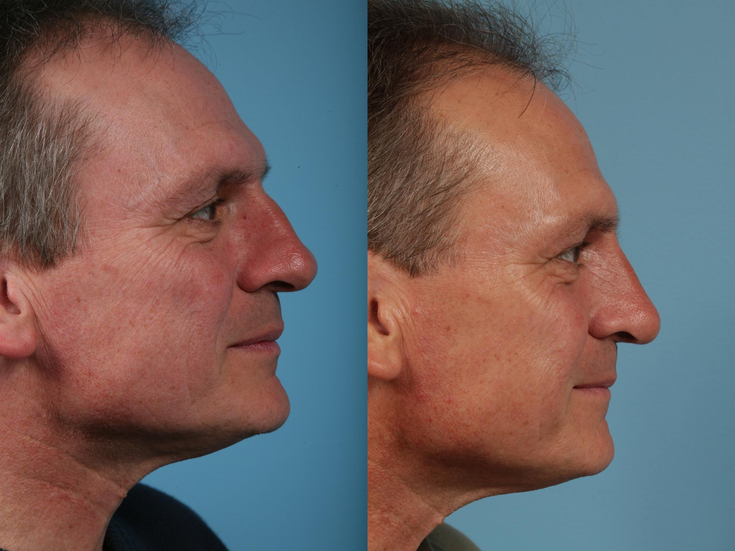 Before & After Rhinoplasty by Dr. Mustoe Case 45 View #2 View in Chicago, IL