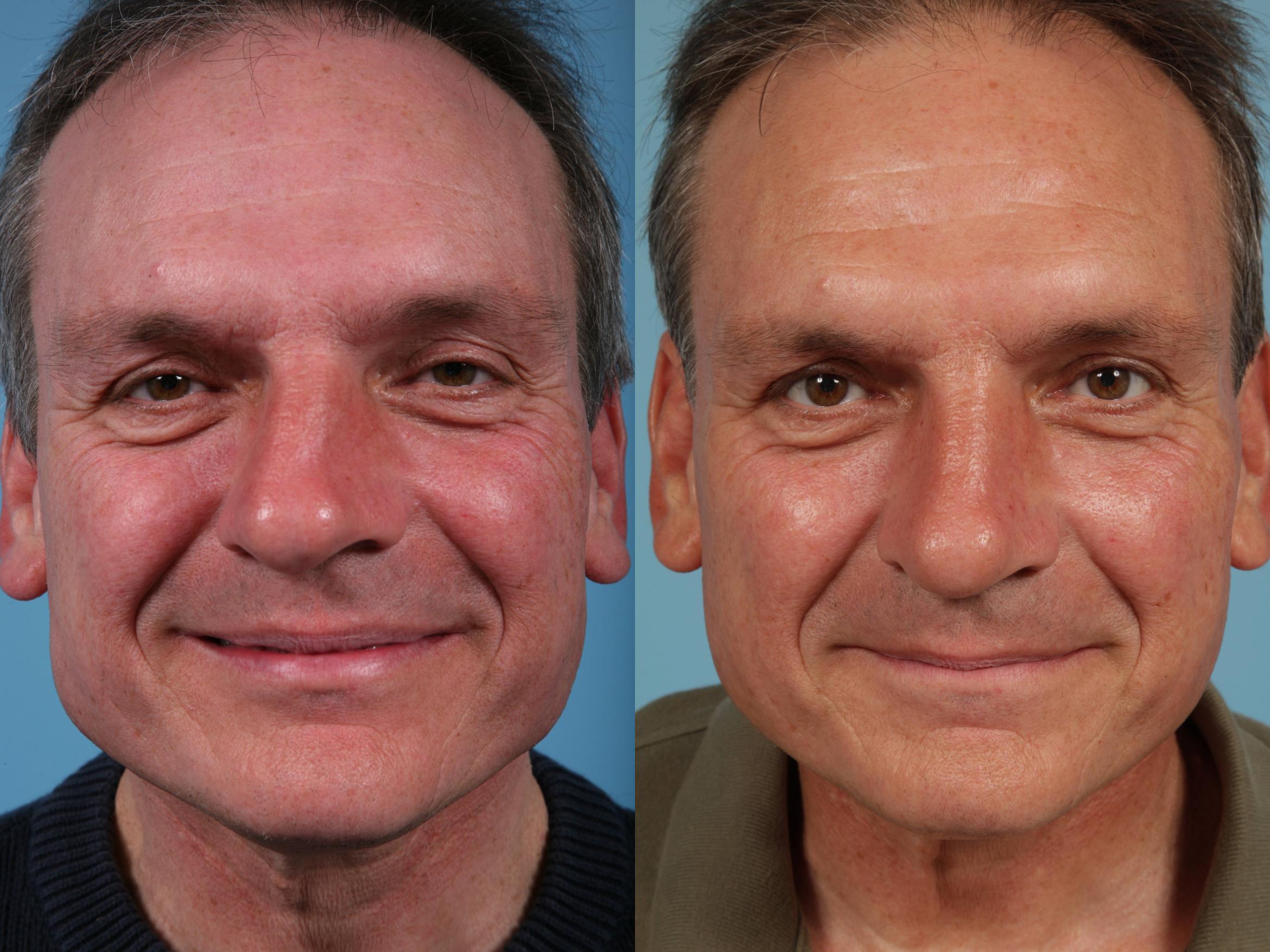 Before & After Rhinoplasty by Dr. Mustoe Case 45 View #3 View in Chicago, IL