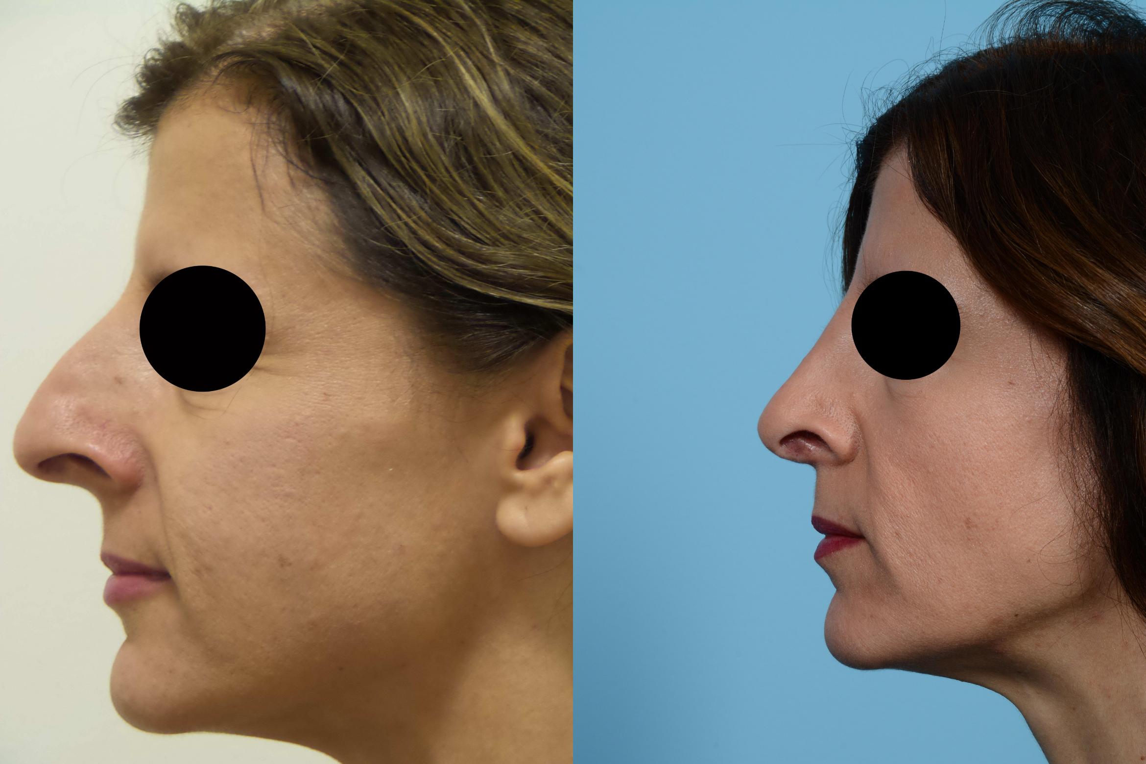 Before & After Rhinoplasty by Dr. Mustoe Case 452 View #1 View in Chicago, IL