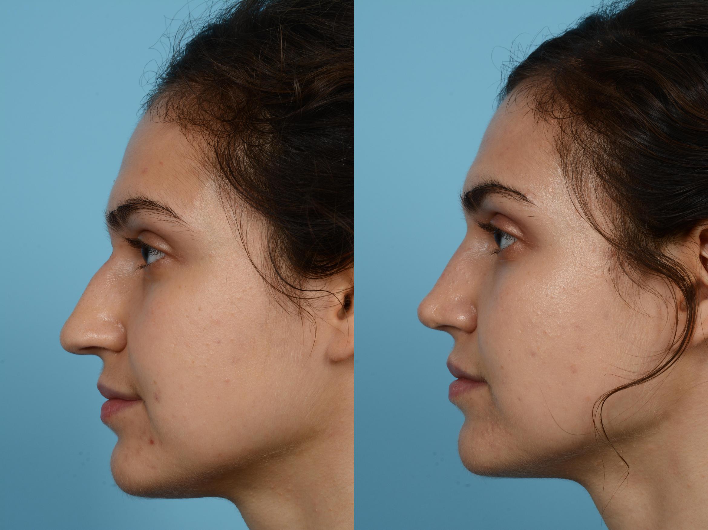 How much does a nose job cost 2011 uk
