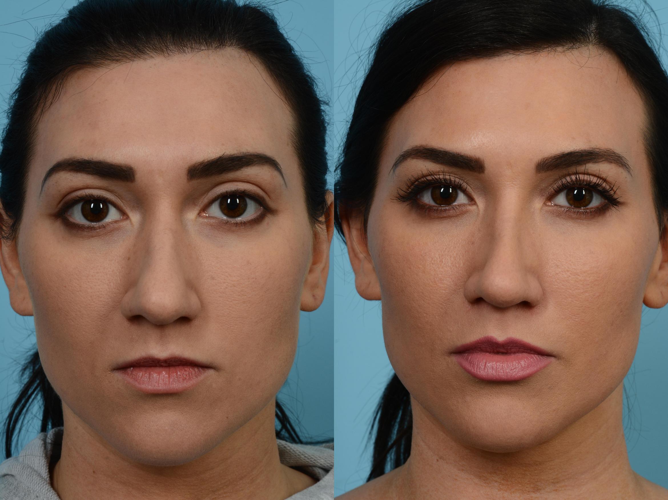 Before & After Rhinoplasty by Dr. Mustoe Case 571 View #1 View in Chicago, IL