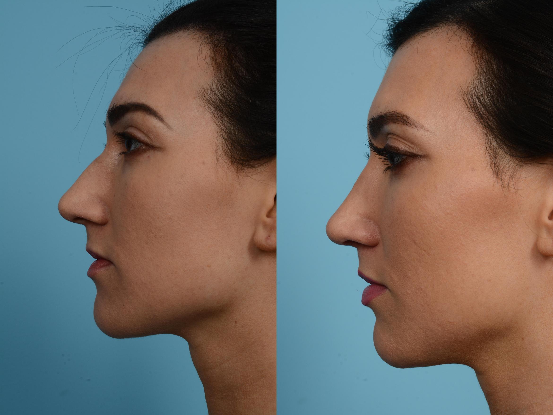 Before & After Rhinoplasty by Dr. Mustoe Case 571 View #2 View in Chicago, IL