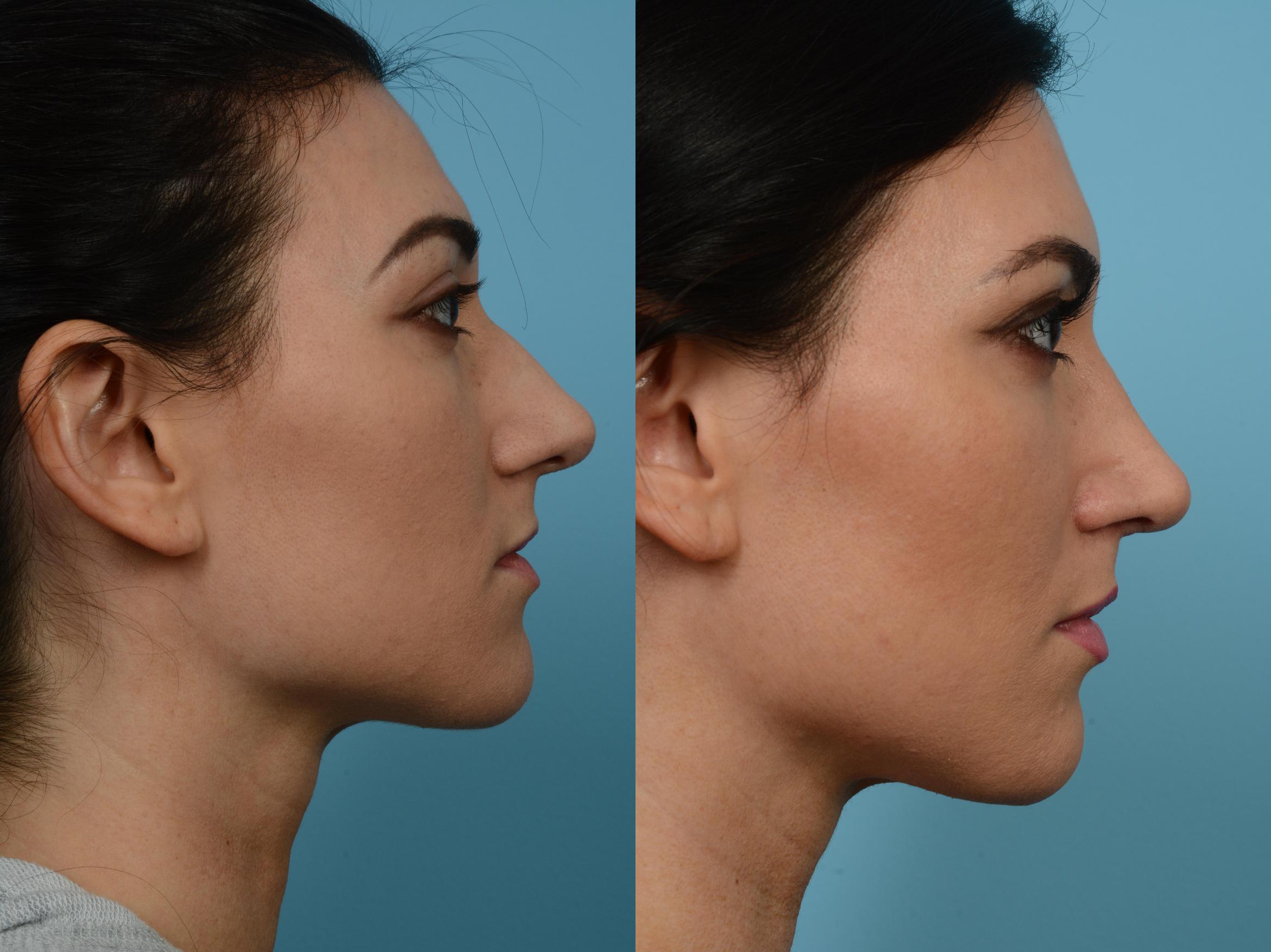 Before & After Rhinoplasty by Dr. Mustoe Case 571 View #3 View in Chicago, IL