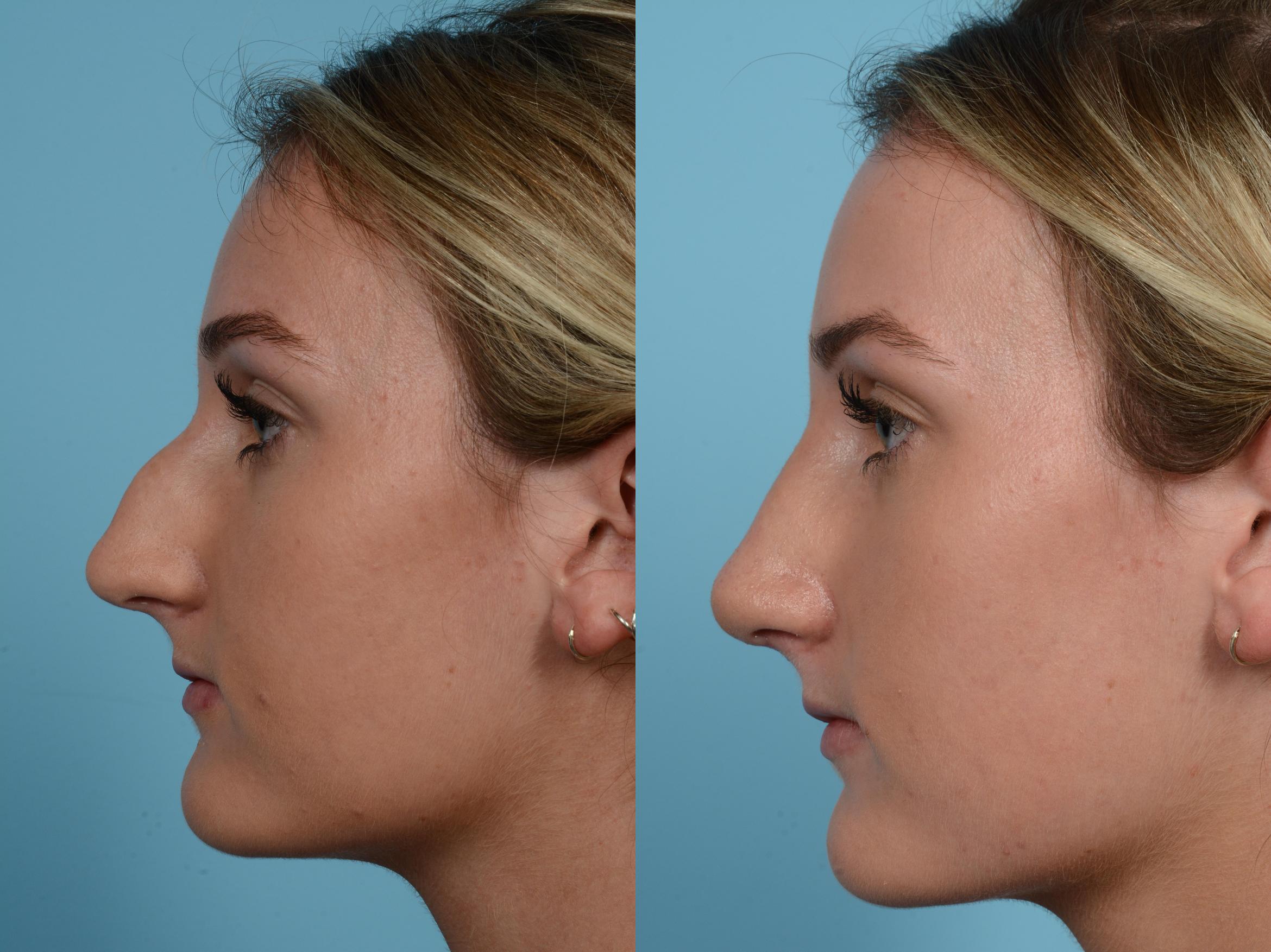 Before & After Rhinoplasty by Dr. Mustoe Case 585 View #1 View in Chicago, IL